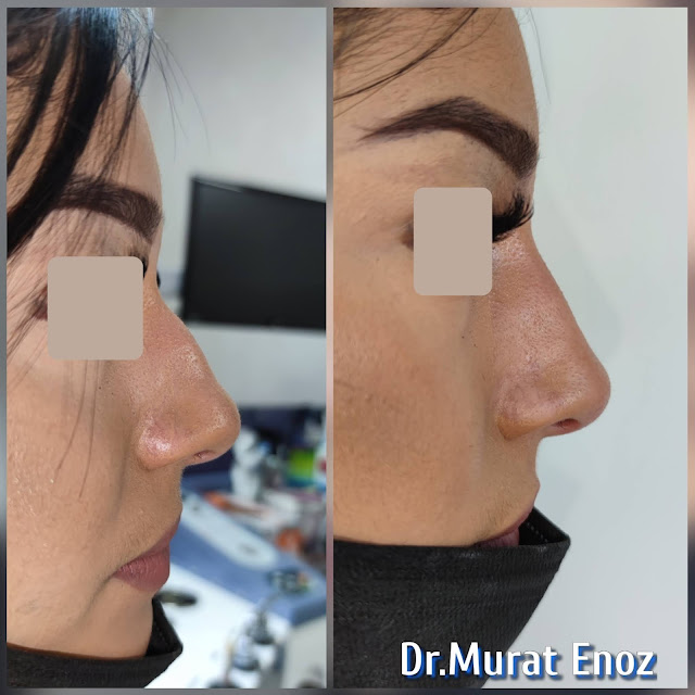 The 5 Minute Nose Job in Istanbul,Nose filler injection Turkey,