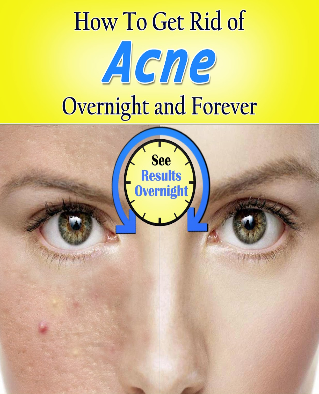 How To Remove Acne Overnight wellness magazine