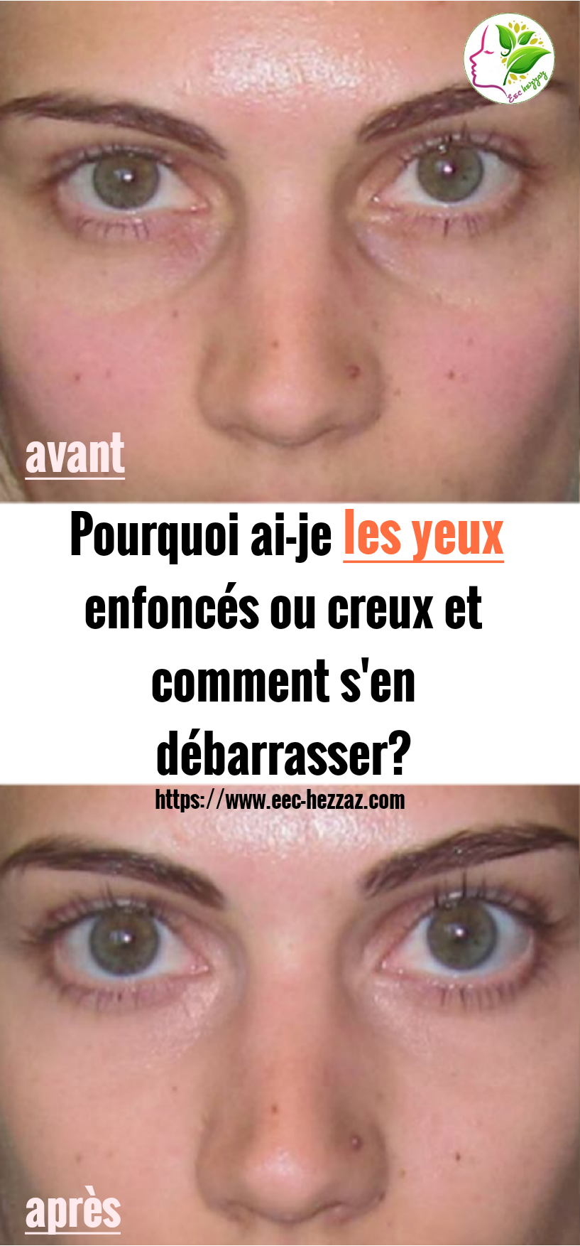 Pourquoi ai-je les yeux enfoncés ou creux et comment s'en débarrasser?