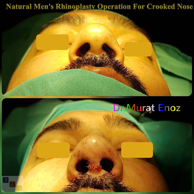 Natural Men's Rhinoplasty Operation For Crooked Nose - Nose Job For Men Istanbul