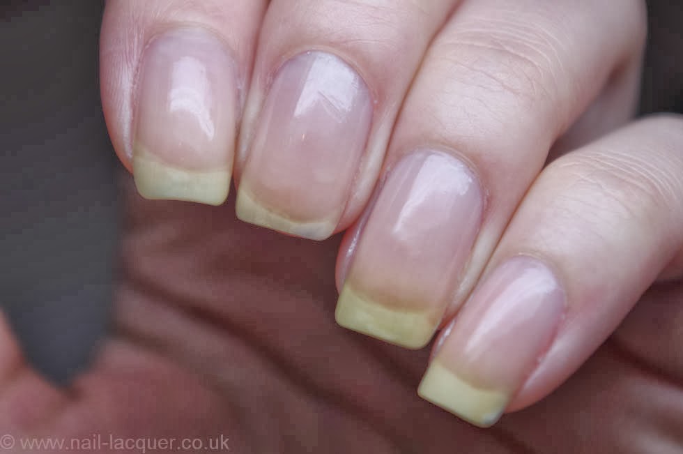 почему пожелтел ноготь на руке