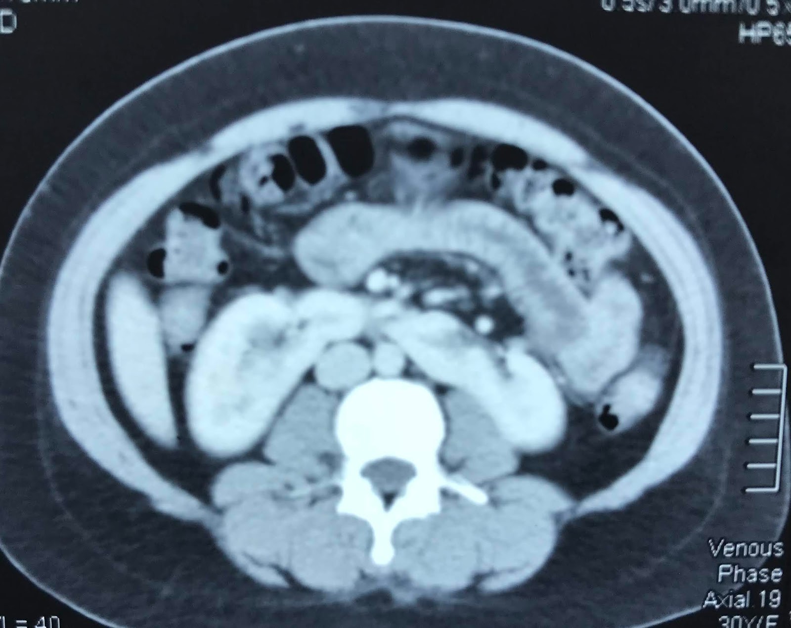 VIETNAMESE MEDIC ULTRASOUND CASE 560 TUMOR IN HORSESHOE KIDNEY, Dr