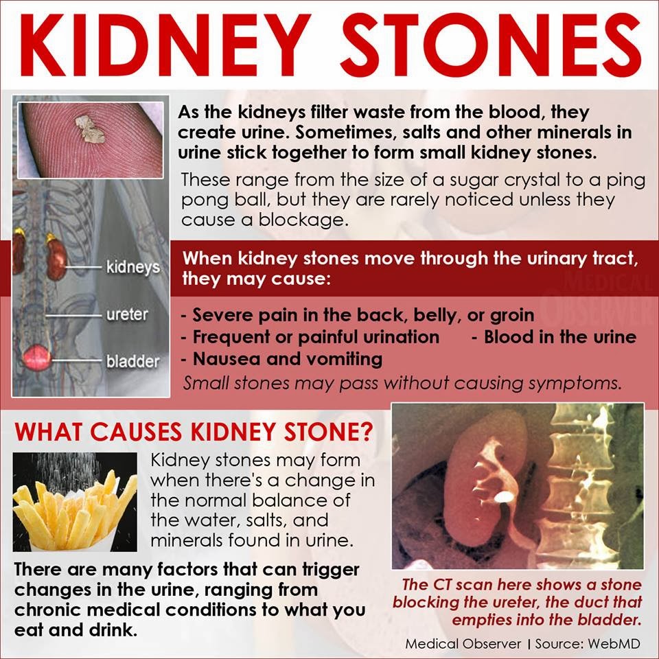 How To Dissolve Kidney Stones Naturally Without Surgery Hydrangea