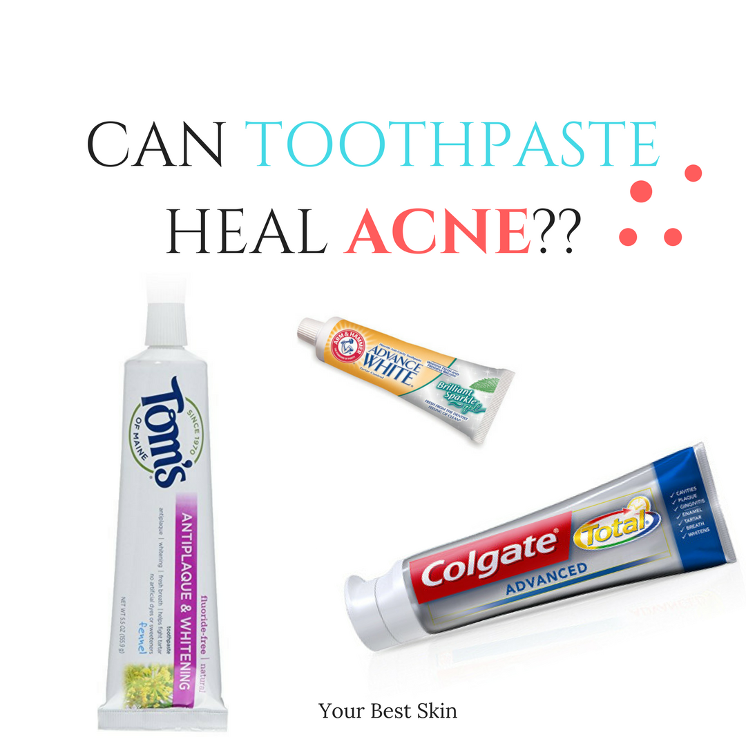 Can Toothpaste Heal Acne?????? Aleithia Wilbert