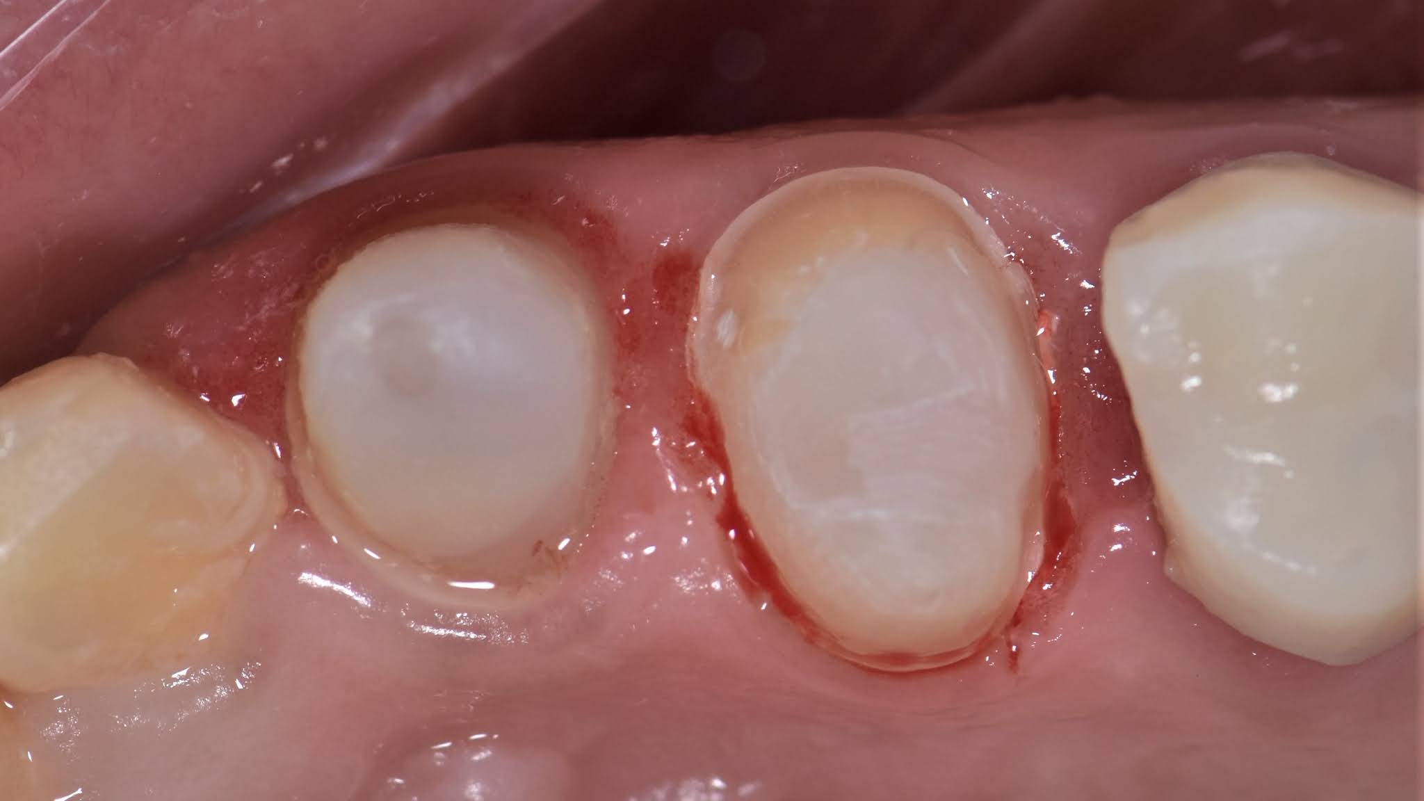 Retraction cords.. Why? When? How? Dental Esthetics