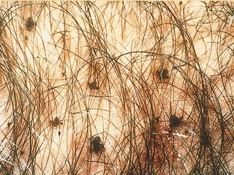 How about a new lifestyle?: PEDICULOSIS AND ITS TREATMENT