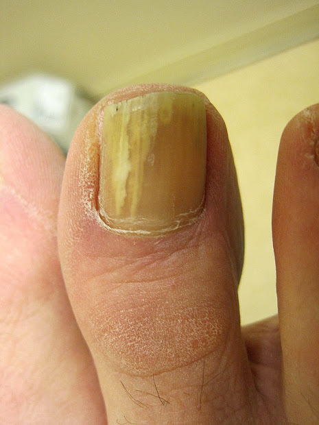 yellow toenails and diabetes
