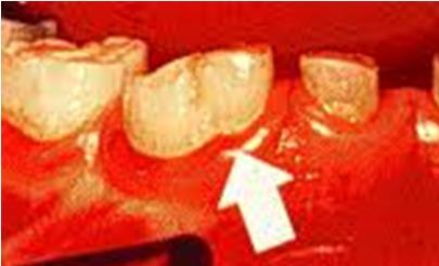 Anomali Gigi: Gigi Kembar “Geminasi dan Fusi” - Terkadang, ada hal yang