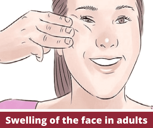 Swelling of the face in adults