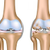 Knee Cartilage Injury First Aid Treatment