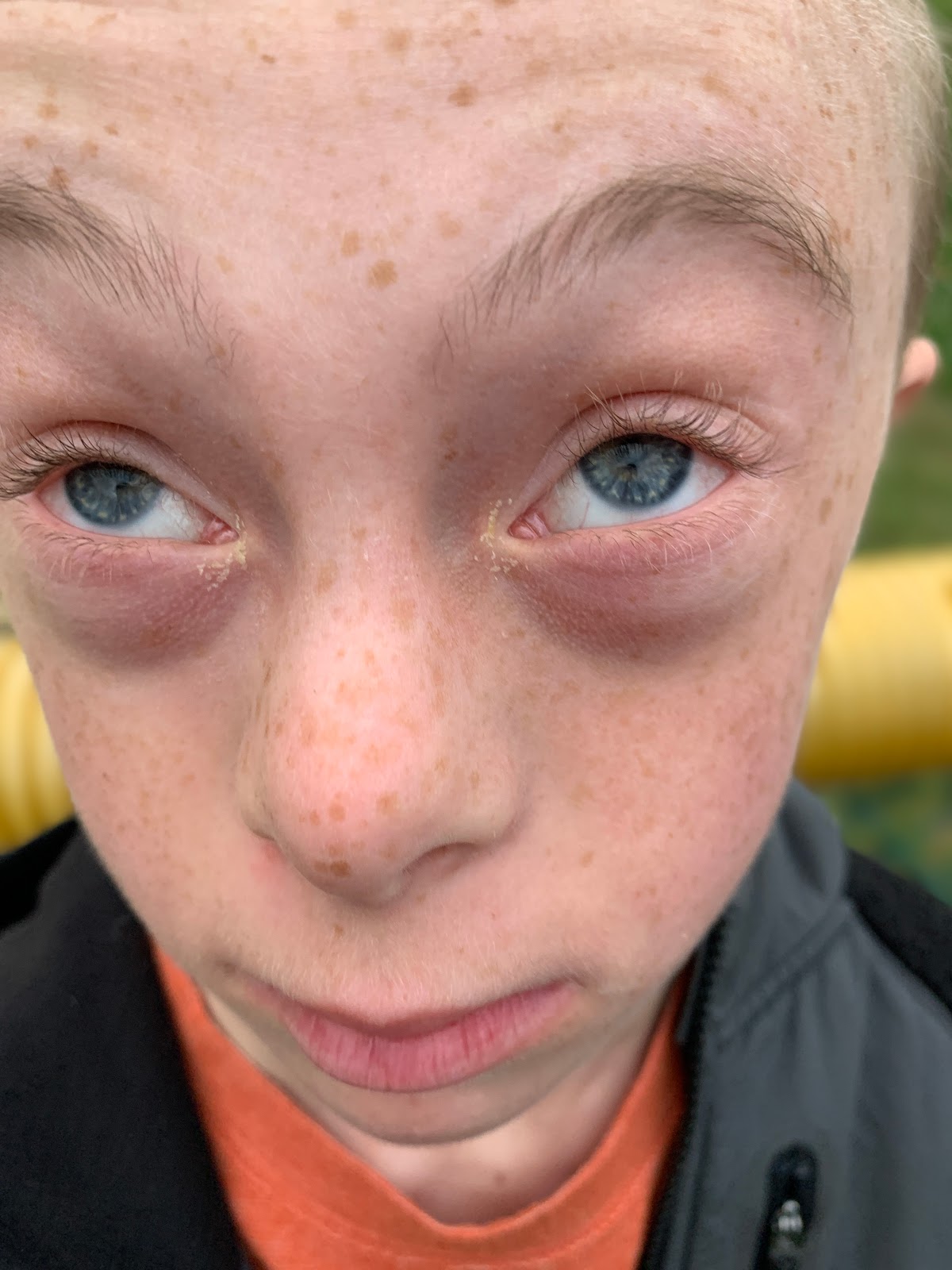 Love for Colin Down Syndrome Awareness Month Colin's Eyes (Day 17)