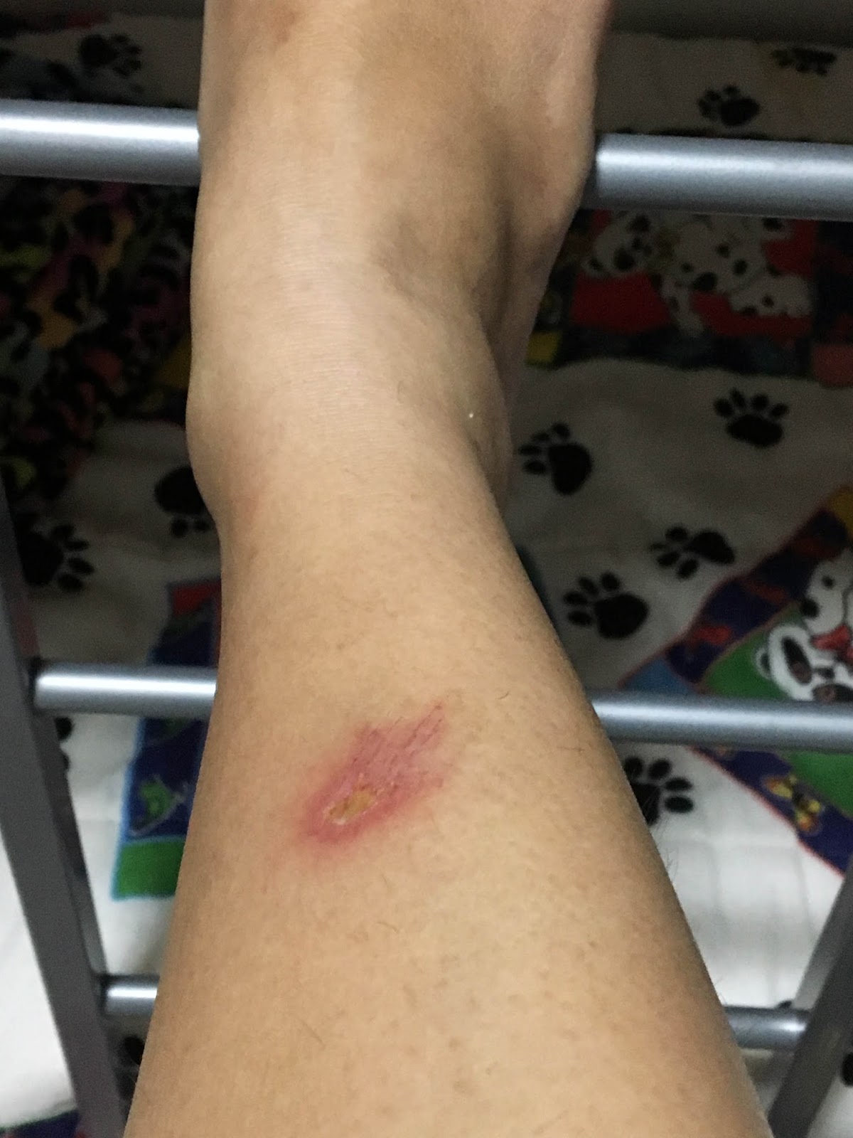 Sonhar Com Pé Machucado De Outra Pessoa Machucados em diabéticos - Sou doce