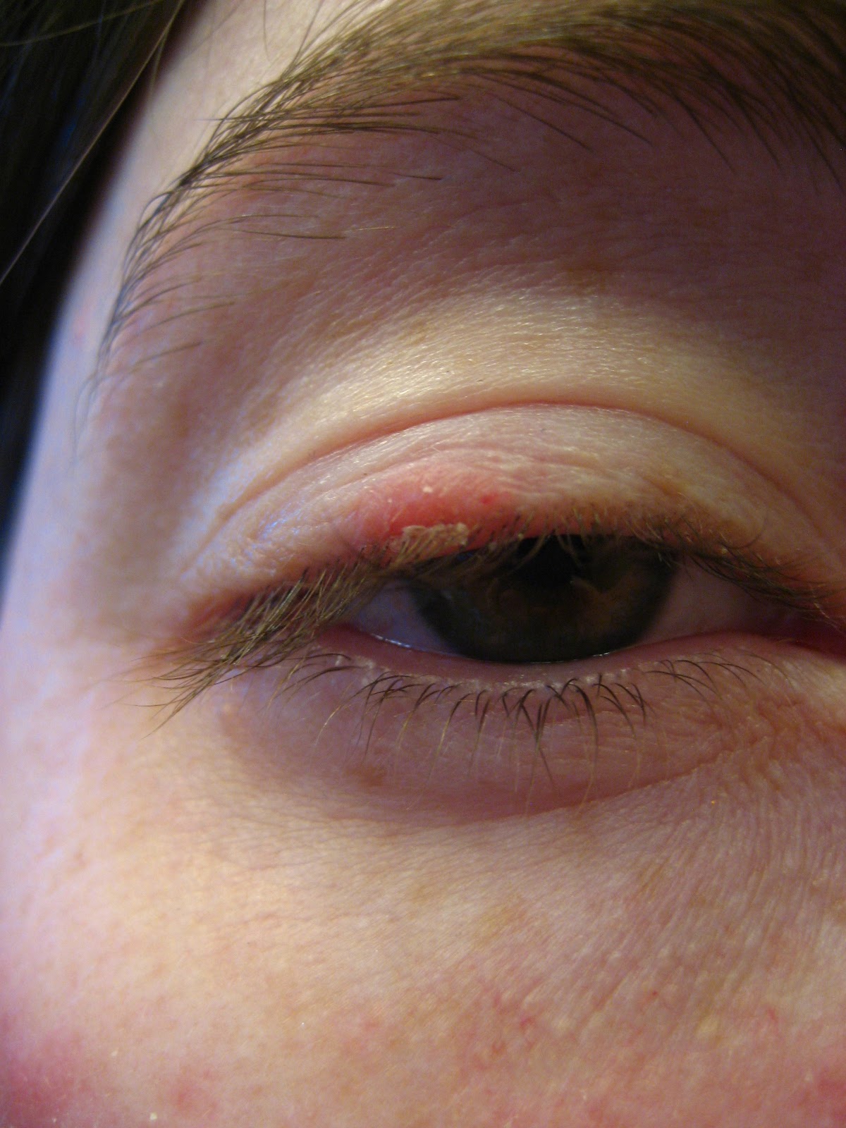 One Woman's Health Watch Sty