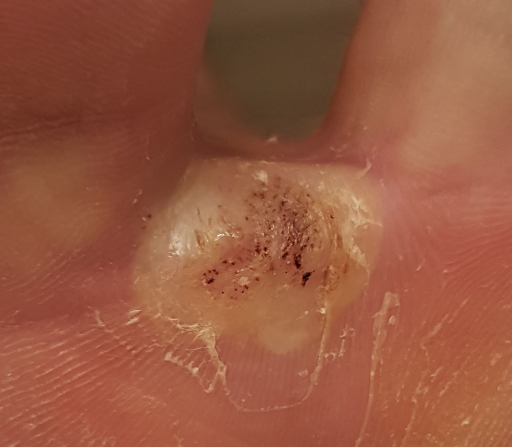Cantharidin - Wart Removal