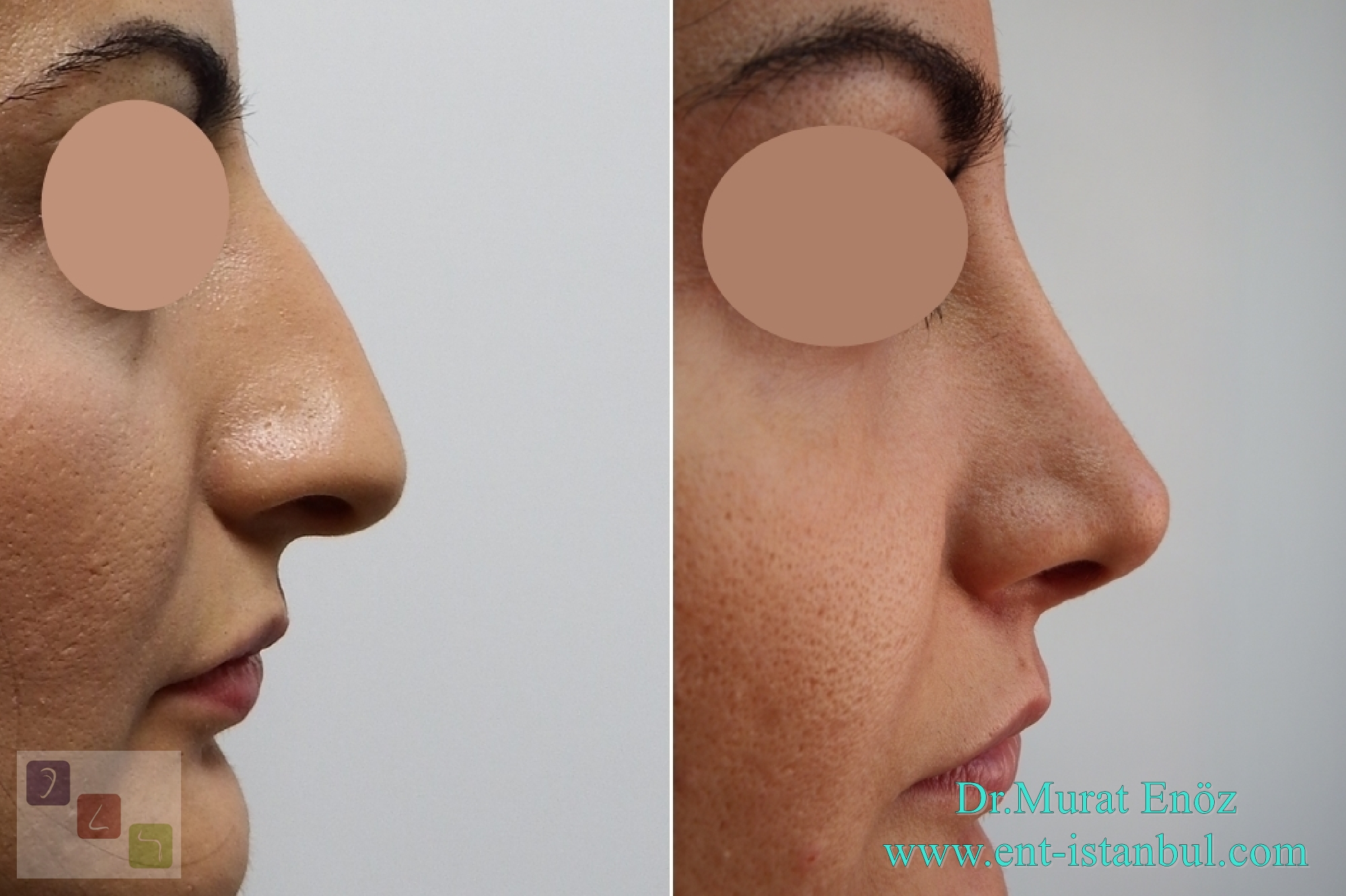 Health Zone Turkey Nose Job in Istanbul, Turkey