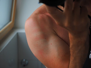 sunburnt-skin