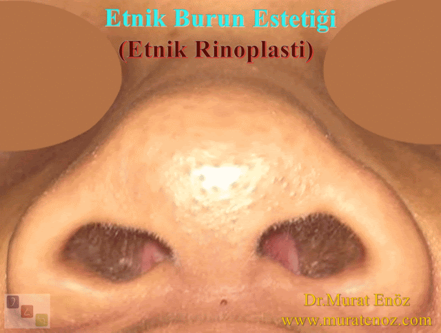 Etnik Burun Estetiği