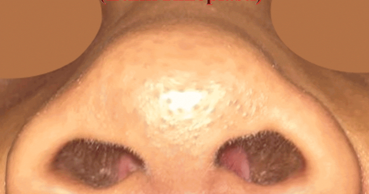 Etnik Burun Estetiği