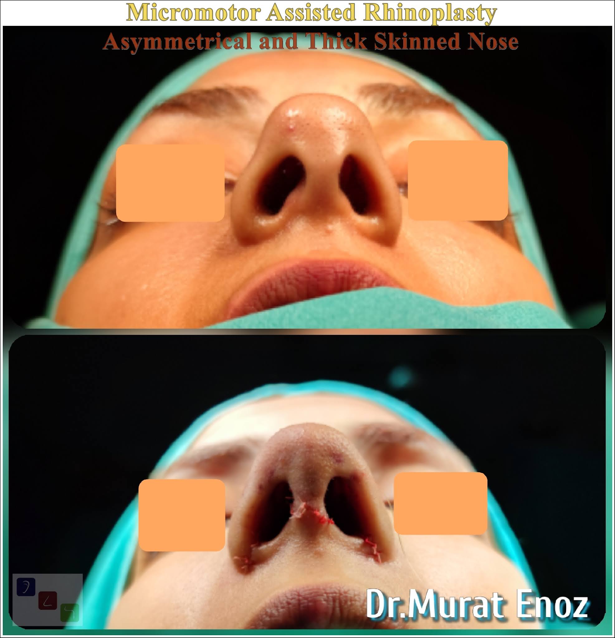 Health Zone Turkey Nose Job in Istanbul, Turkey