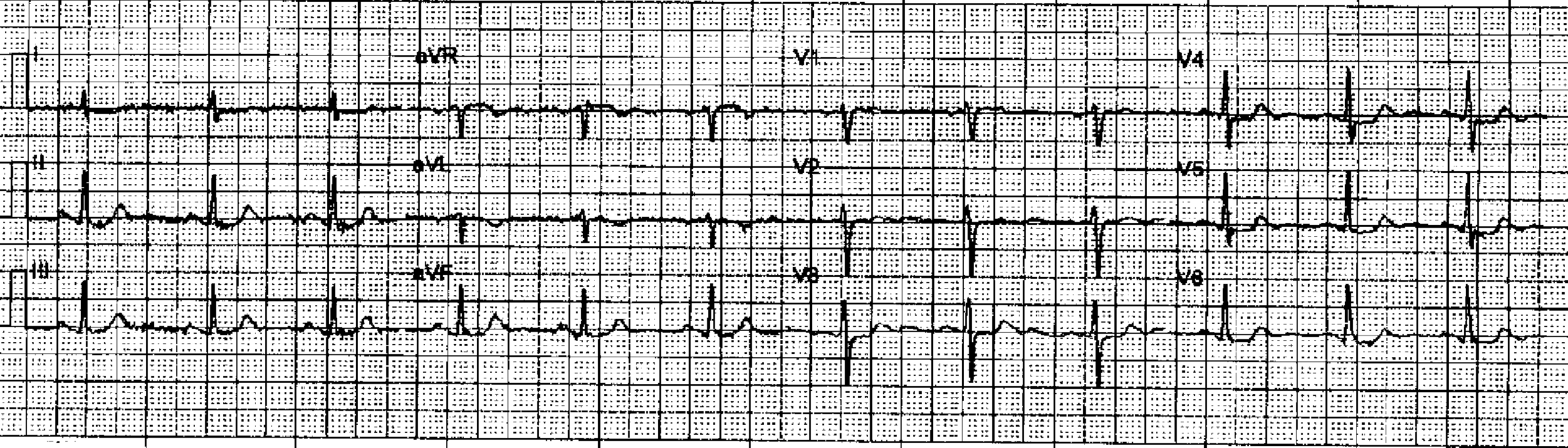 Dr. Smith's ECG Blog Atrial Fibrillation w Rapid Ventricular Response