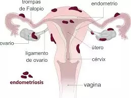 How To Explain Endometriosis Pain | 2020 | Good Advice For Endometriosis Pain