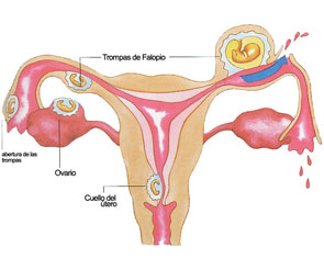 hemorragia uterina disfuncional