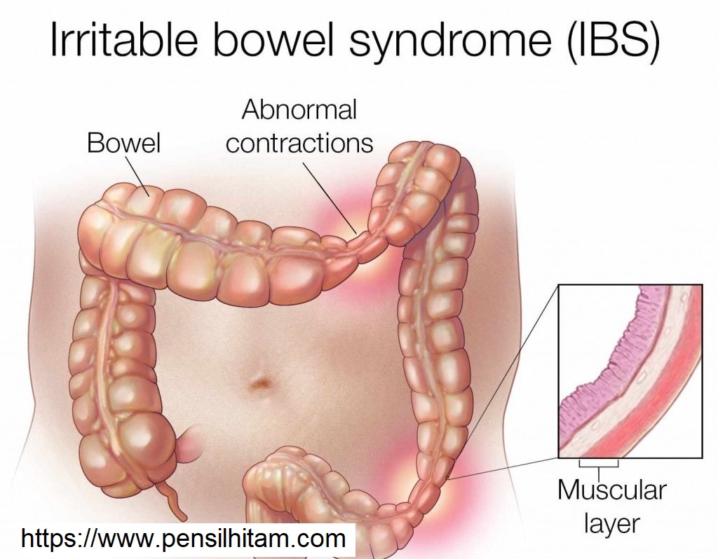 Colon irritable que comer