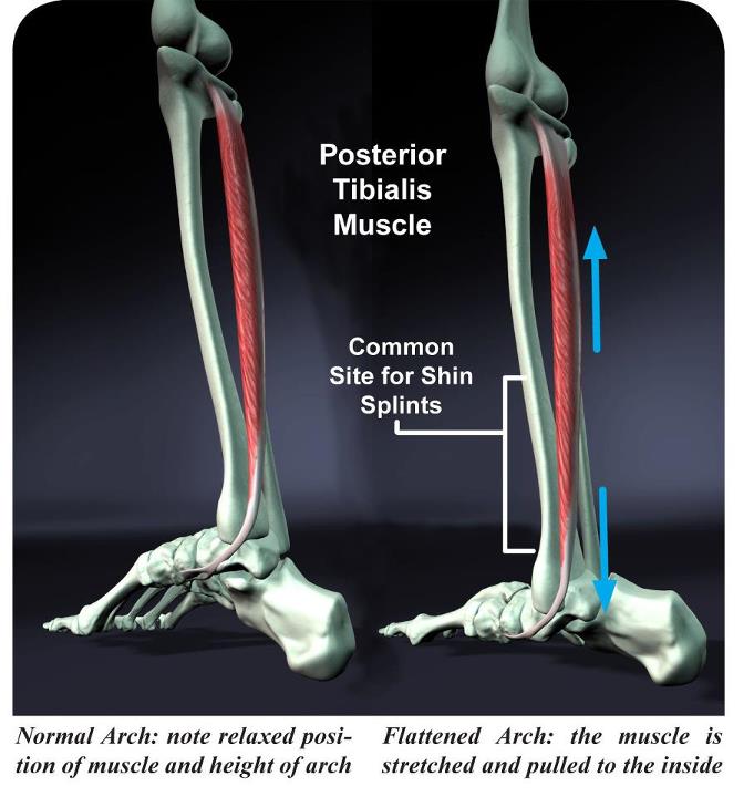 Corre al Fisio!! Cas clínic "Periostitis tibial"