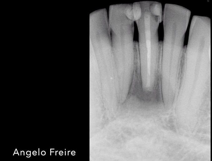 ENDODONTIA: Retroinstrumentação ultrassônica associada ao Endogel