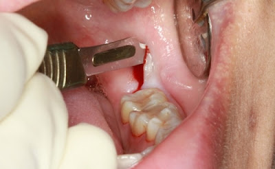 Giải đáp thắc mắc vì sao nhổ răng khôn bị chảy máu?