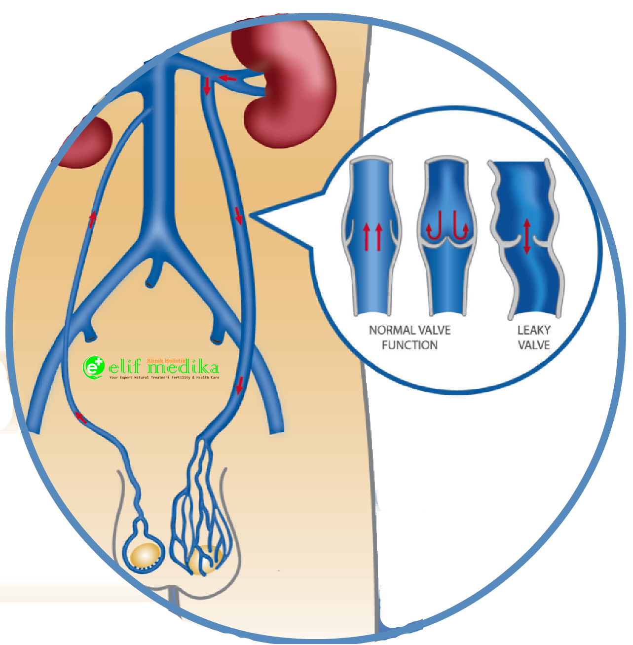 Gejala Varikokel  Testis Grade 1 2 dan 3