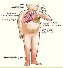 أعراض قصور القلب أعراض قصور القلب