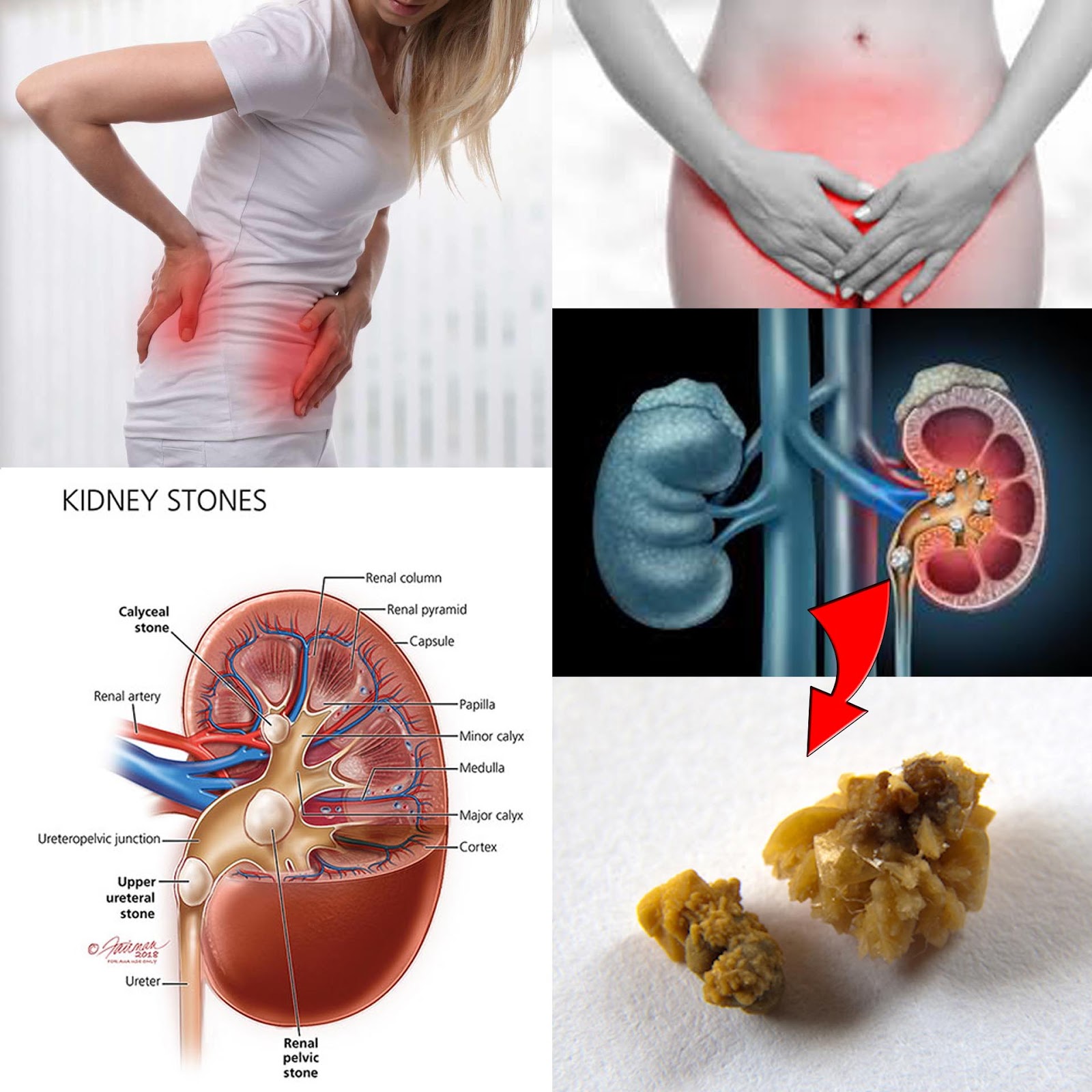 can too much calcium cause kidney pain