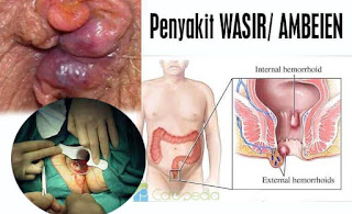 Obat Ambeien apotik paling ampuh sembuh total