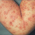 Tips Dan Cara Mengobati Penyakit Herpes Pada Tangan