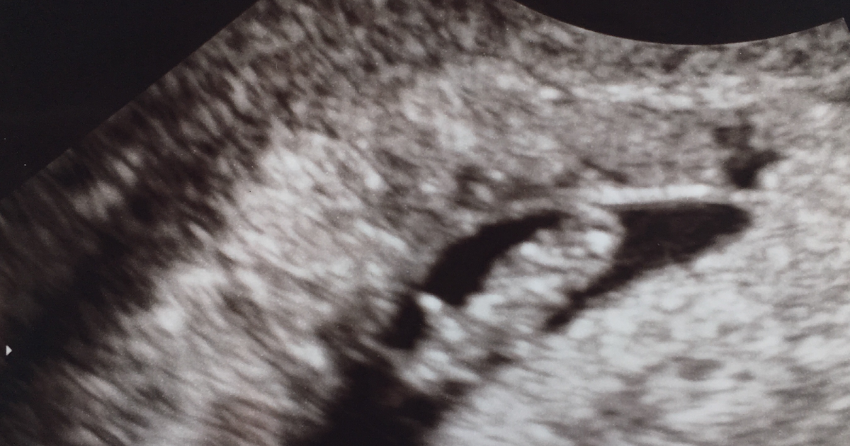 A Few Good Eggs First Ultrasound