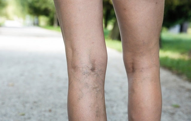 how to get rid of varicose veins treatment spider veins