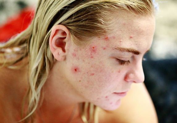 चेहऱ्यावरील मुरूम जाण्यासाठी उपाय-Pimples Skin care: Pimples Skin care tips in marathi,Pimple skin care tips,kin Care Tips For Fighting Pimples,sensitive skin,Skin Care Tips