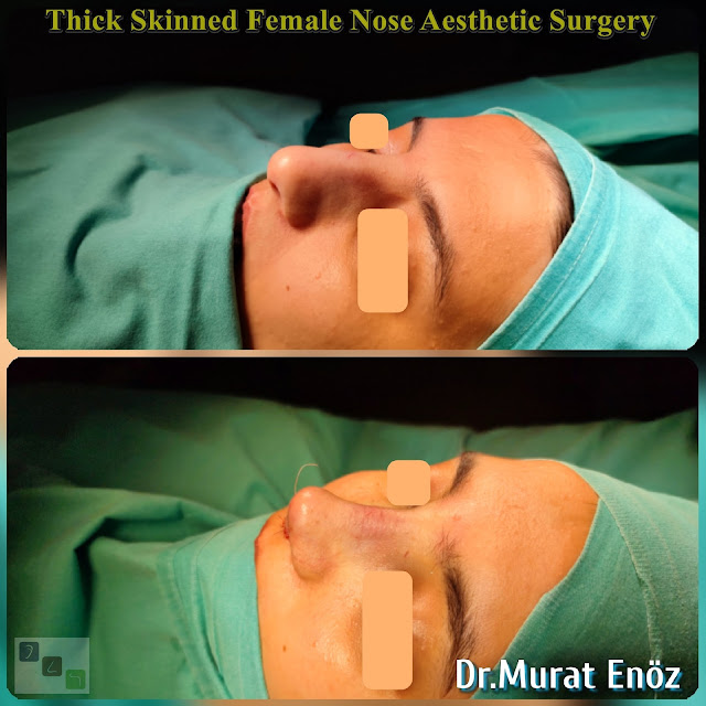 femal nose job,rhinoplasty operation in istanbul,nose job for women,thick skinned nose aesthetic,Ethnic rhinoplasty,nose job for thick skinned nose,