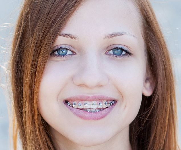 Escondido Orthodontics Do I really need to wear rubber bands with my