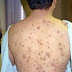 Familial neoplasm: Neurofibromatosis type 1 and type 2
