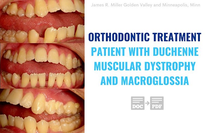 PDF: Orthodontic treatment of a patient with Duchenne muscular dystrophy and macroglossia: How informed consent was critical to success