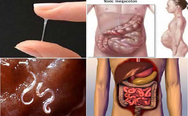 Natural Remedy For Parasites In Your Stomach Natural Remedy For Parasites In Your Stomach