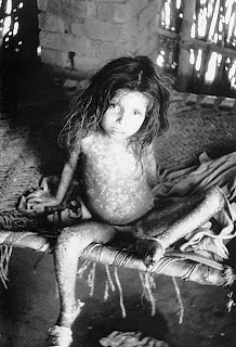 Sıradan tipte çiçek hastalığı (variola major) nedeniyle döküntü gösteren bir çocuk