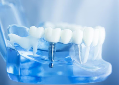 Cấy ghép răng implant thực hiện thế nào?