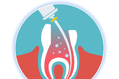 En que consiste una endodoncia