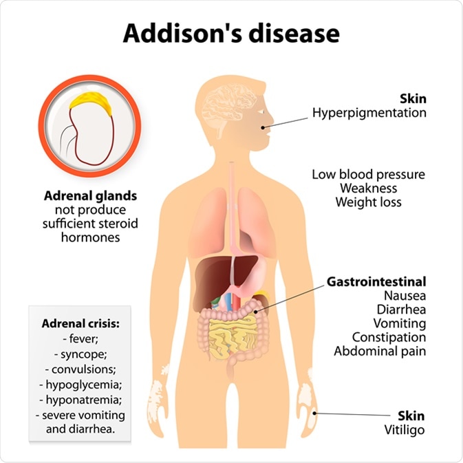 Addison’s Disease - Dasherfa