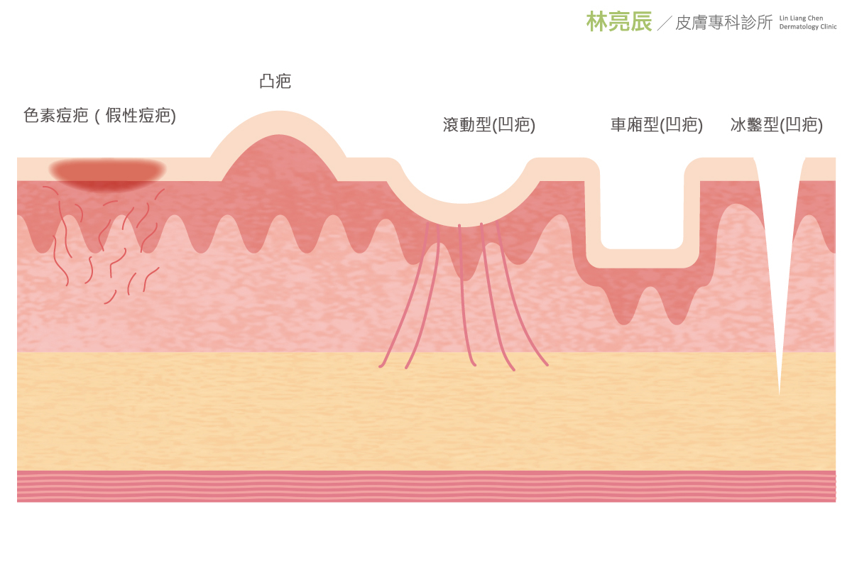 副作用除斑凹洞淨膚雷射UP雷射UltraPulse痘疤凹疤痘疤淡化凹疤修復PicoSure755皮秒雷射蜂巢式聚焦陣列透鏡蜂巢透鏡雀斑曬斑除斑痘疤毛孔細紋問答qa755蜂巢皮秒雷射二代皮秒超皮秒新一代皮秒雷射新竹皮秒雷射推薦醫師皮膚科醫師痘疤凹疤飛梭雷射皮秒雷射價格價錢術後保養M22彩衝光紅色痘疤多久消痘疤種類 副作用除斑凹洞淨膚雷射UP雷射UltraPulse痘疤凹疤痘疤淡化凹疤修復PicoSure755皮秒雷射蜂巢式聚焦陣列透鏡蜂巢透鏡雀斑曬斑除斑痘疤毛孔細紋問答qa755蜂巢皮秒雷射二代皮秒超皮秒新一代皮秒雷射新竹皮秒雷射推薦醫師皮膚科醫師痘疤凹疤飛梭雷射皮秒雷射價格價錢術後保養M22彩衝光紅色痘疤多久消痘疤種類