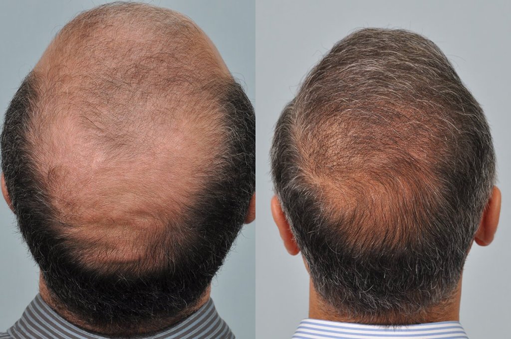 Crown Hair Transplant AT Hair Transplant Dubai Clinic Best Hair