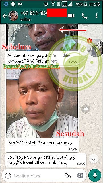 Obat Gatal Di Selangkangan Dan Kelamin Tradisional Terbukti Mujarab ~ TESTIMONI QNC JELLY GAMAT Obat Gatal Di Selangkangan Dan Kelamin Tradisional Terbukti Mujarab ~ TESTIMONI QNC JELLY GAMAT